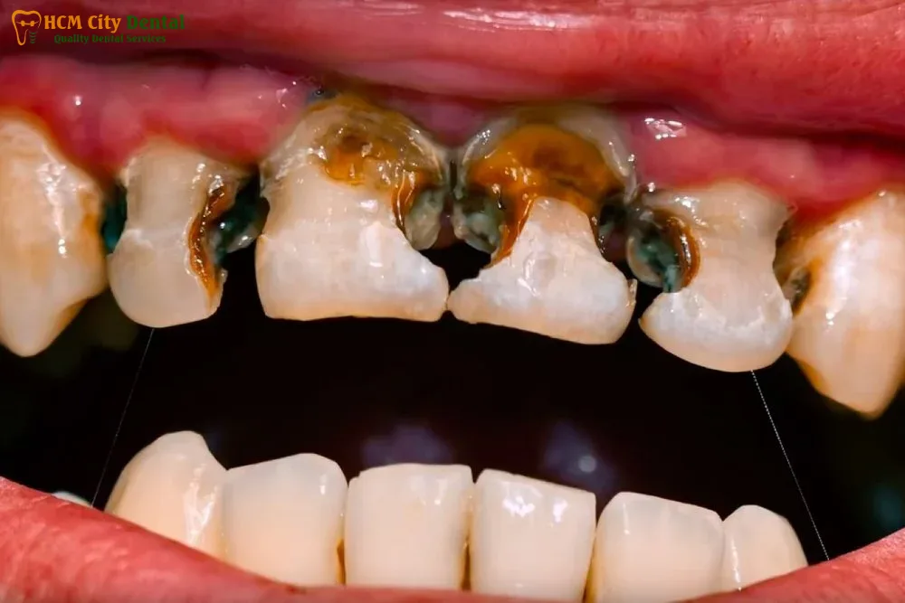 an-keo-sau-rang-2-bac-si-cuong-nha-khoa-bscuong-bac-si-cuong-nha-khoa-bscuong