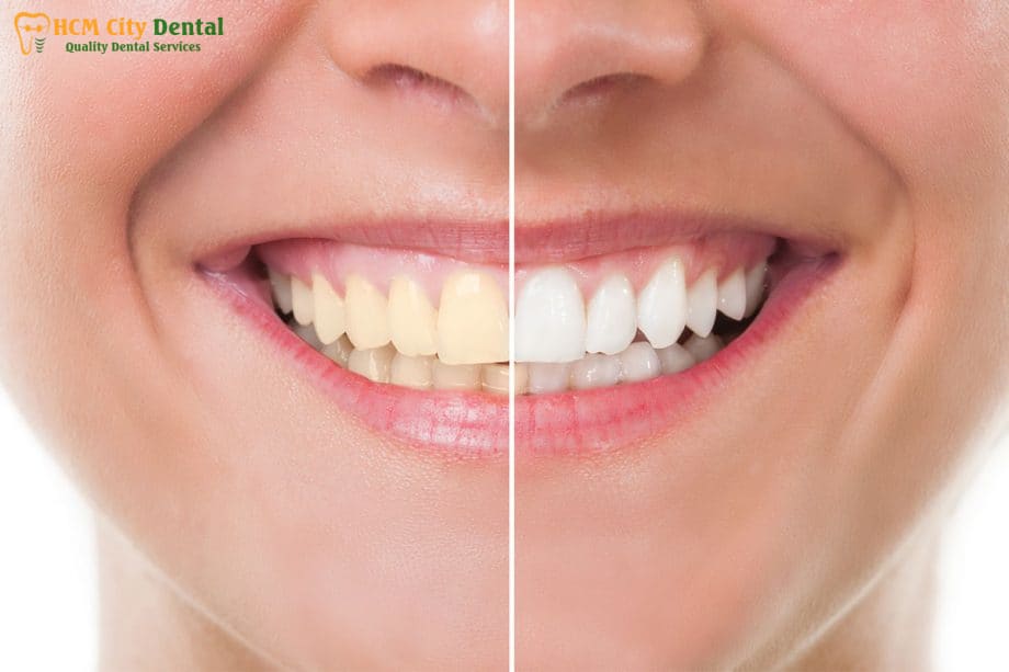 tay-trang-rang-nha-khoa-gia-bao-nhieu-5-bac-si-cuong-nha-khoa-bscuong-bac-si-cuong-nha-khoa-bscuong