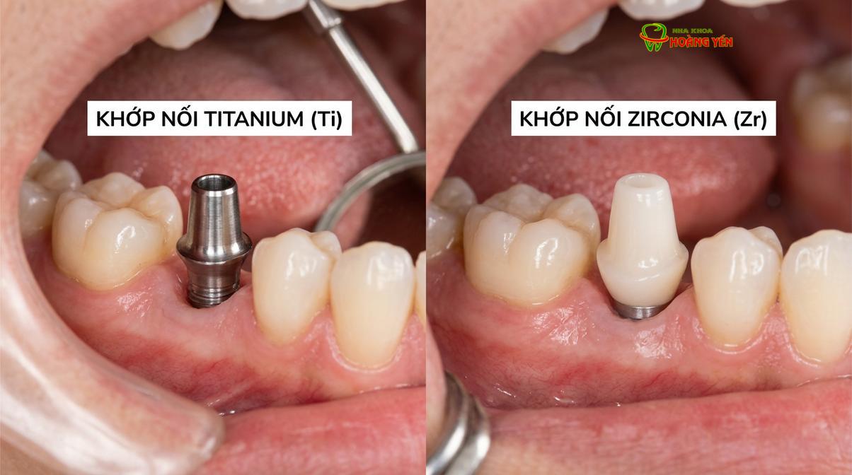 Sự khác biệt về mặt thẩm mỹ giữa khớp nối Titanium và khớp nối toàn sứ Zirconia.
