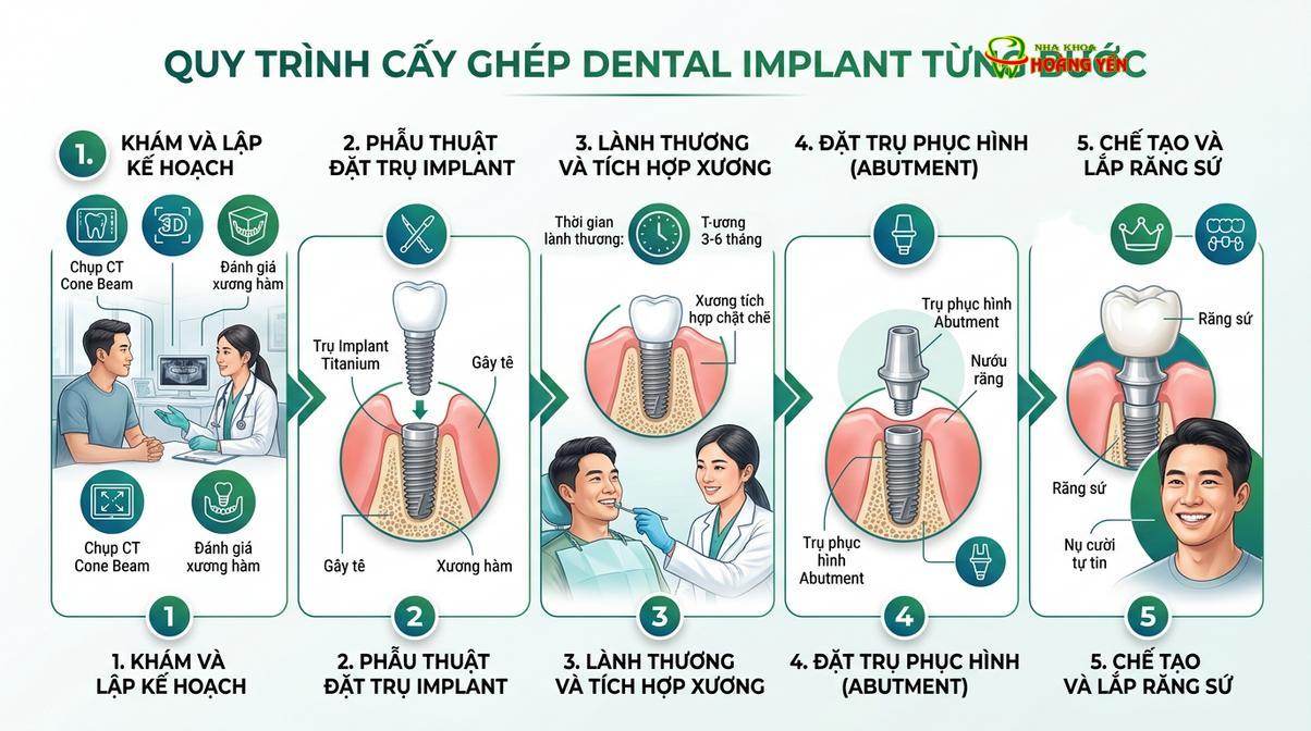 Quy trình cấy ghép implant chuẩn y khoa đòi hỏi sự chính xác và kiểm soát nhiễm khuẩn nghiêm ngặt.