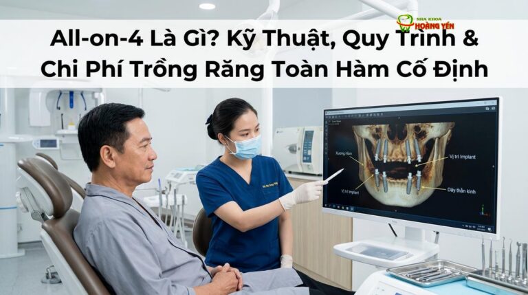 All-on-4 Là Gì? Kỹ Thuật, Quy Trình & Chi Phí Trồng Răng Toàn Hàm