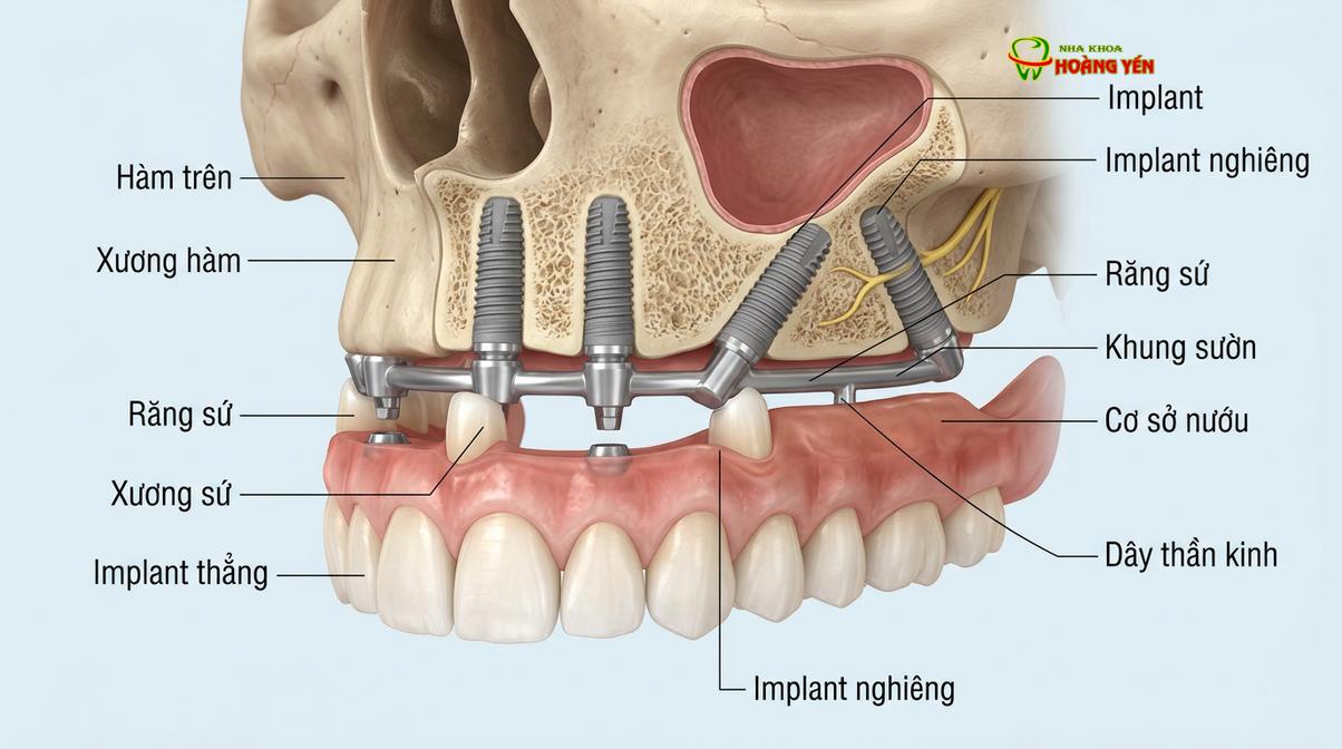 Cơ chế lực sinh học của kỹ thuật All-on-4 với 2 trụ nghiêng phía sau