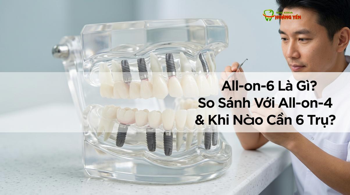 Mô phỏng cấu trúc 6 trụ implant được cấy ghép vững chắc vào xương hàm để nâng đỡ toàn bộ phục hình sứ.