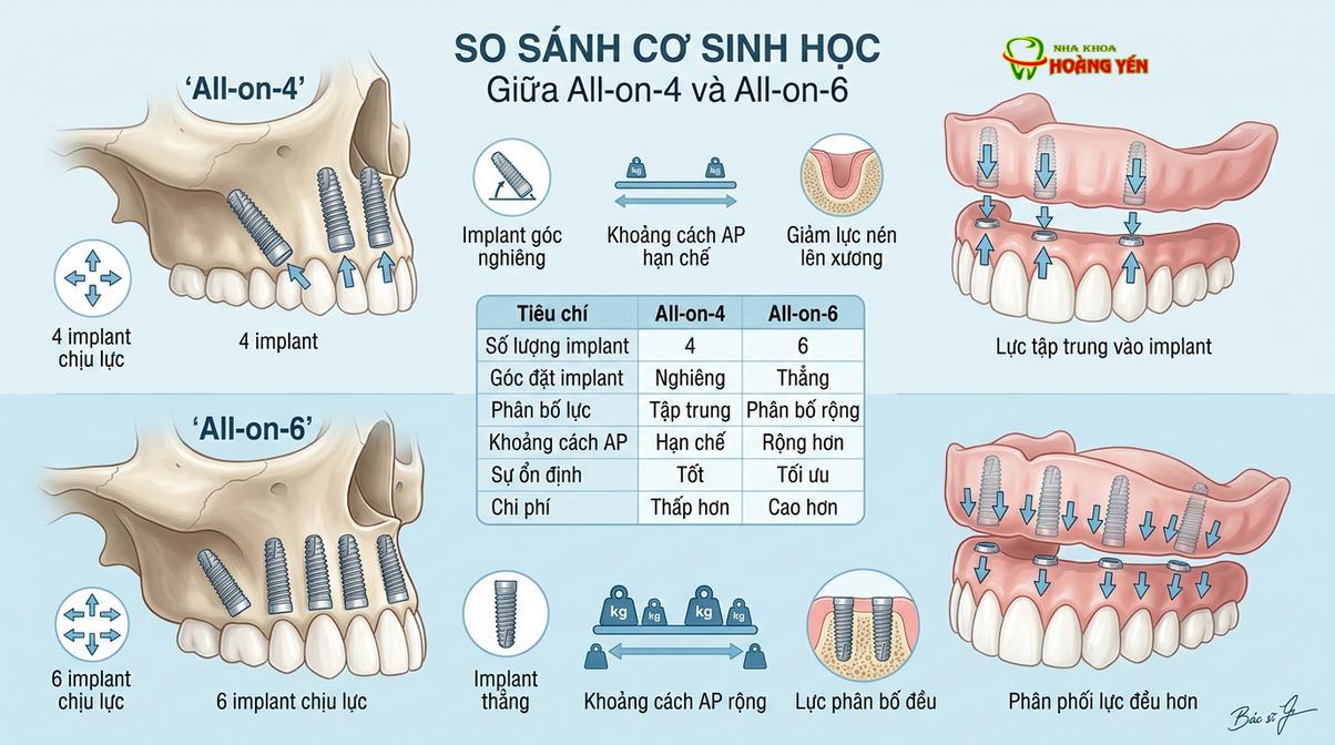 Sự khác biệt về phân bố lực cơ học giữa kỹ thuật All-on-4 và All-on-6.