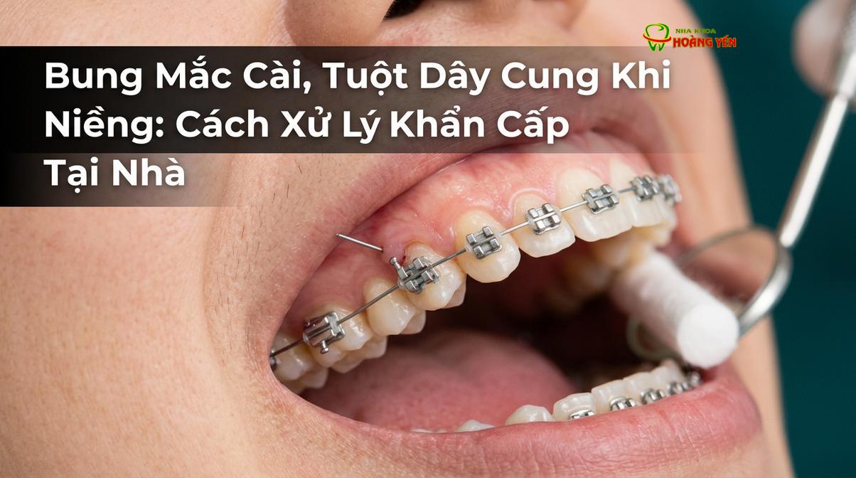 Hình ảnh thực tế tình trạng mắc cài bị bung và trượt tự do trên dây cung chỉnh nha.