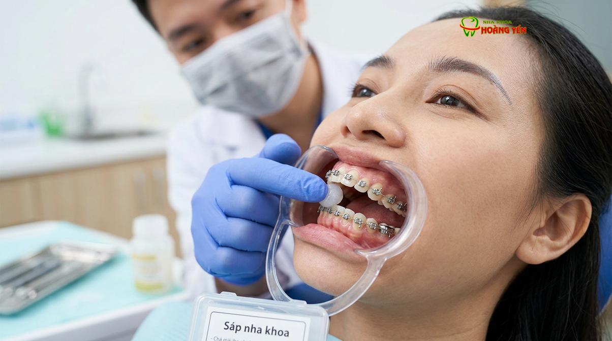 Sử dụng sáp nha khoa là biện pháp sơ cứu hiệu quả nhất để giảm ma sát khi khí cụ bị tuột.
