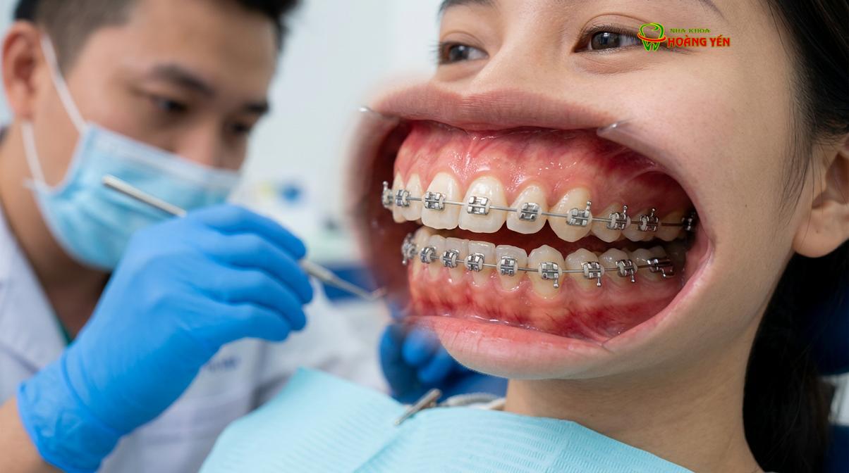 Mô phỏng cơ chế sinh học trong giai đoạn dàn đều và san phẳng cung răng.