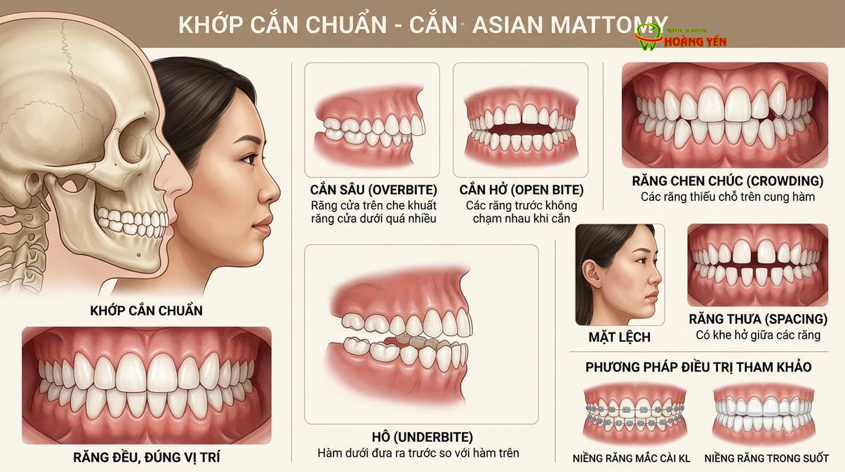 Các tình trạng sai lệch khớp cắn quyết định việc lựa chọn gói điều trị Invisalign.