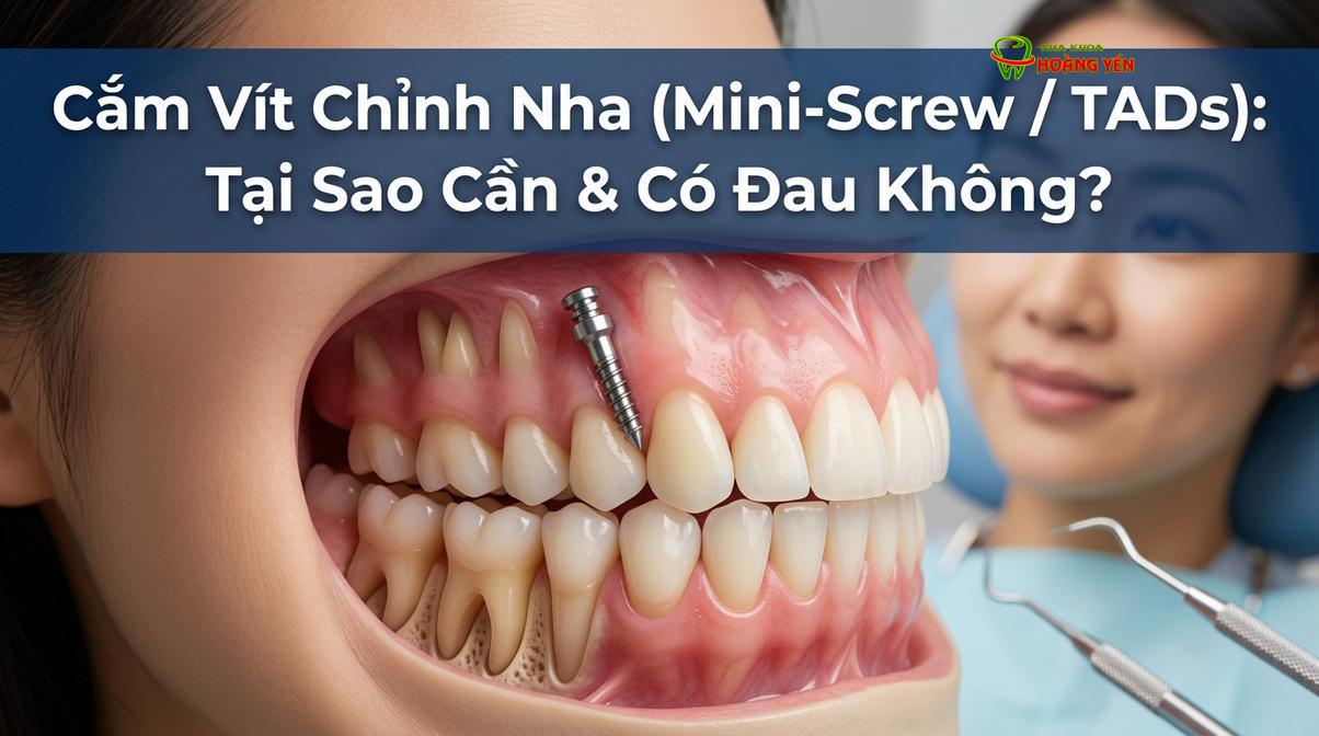 Vít chỉnh nha (mini-screw) có kích thước rất nhỏ, được cấy trực tiếp vào xương hàm để tạo điểm neo chặn.