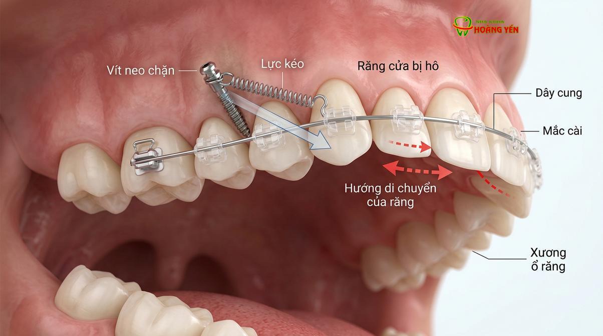 Mô phỏng cơ chế hoạt động của vít neo chặn trong việc kéo lùi nhóm răng cửa để khắc phục tình trạng hô vẩu.