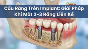 Visual illustration of cầu răng trên implant