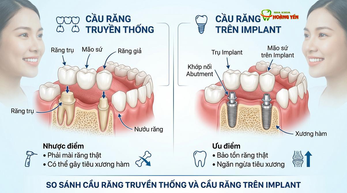 Sự khác biệt về cơ chế bảo tồn xương hàm giữa cầu răng sứ truyền thống và cầu răng implant.
