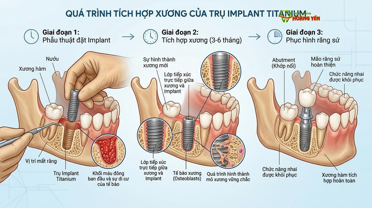 Quá trình tích hợp xương sinh học là yếu tố quyết định sự vững chắc của chân răng nhân tạo.