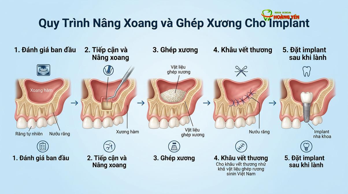 Kỹ thuật ghép xương và nâng xoang tạo nền tảng vững chắc cho trụ implant.