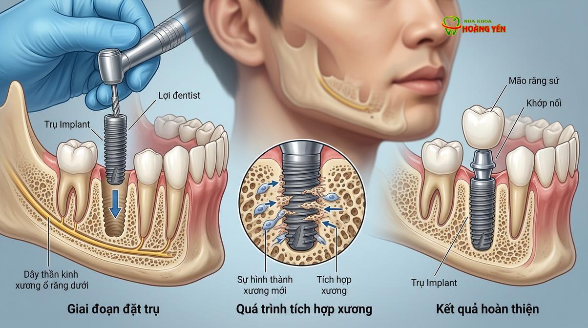 Cấu tạo chi tiết của một chiếc răng implant hoàn chỉnh bao gồm trụ Titanium, khớp nối Abutment và mão răng sứ.