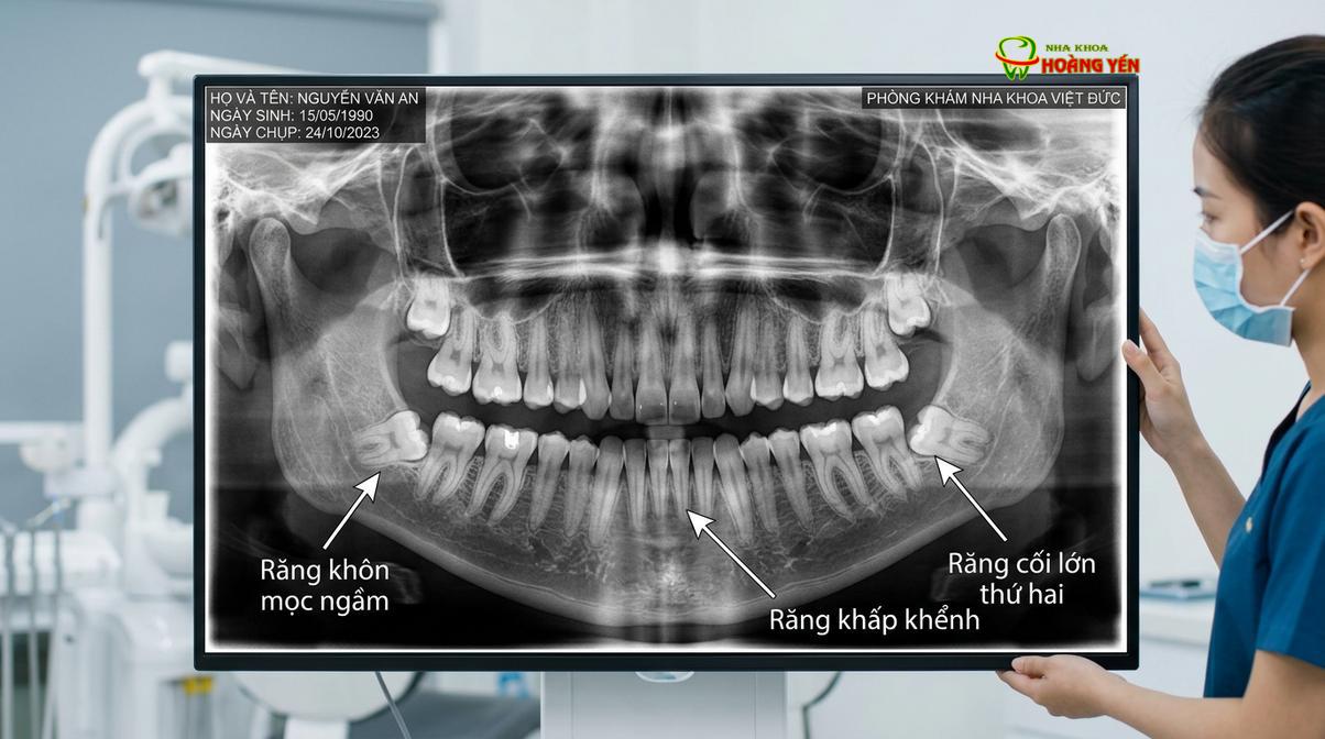 Chụp phim X-quang giúp bác sĩ đánh giá chính xác cấu trúc xương hàm và vị trí các chân răng.