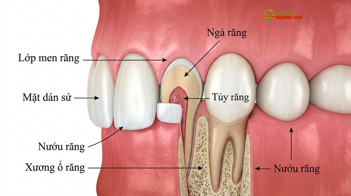 Mặt dán sứ veneer siêu mỏng được gắn lên bề mặt ngoài của răng sau khi trục răng đã được chỉnh thẳng.