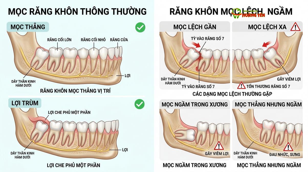 Sự khác biệt về mặt giải phẫu giữa răng khôn mọc thẳng và răng khôn mọc lệch ngầm.