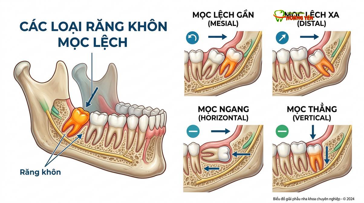 Các thế mọc lệch phổ biến của răng khôn gây chèn ép và tổn thương cấu trúc răng lân cận.