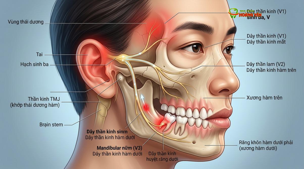 Sơ đồ minh họa đường đi của dây thần kinh sinh ba, giải thích hiện tượng đau lan từ răng khôn lên đầu và tai.
