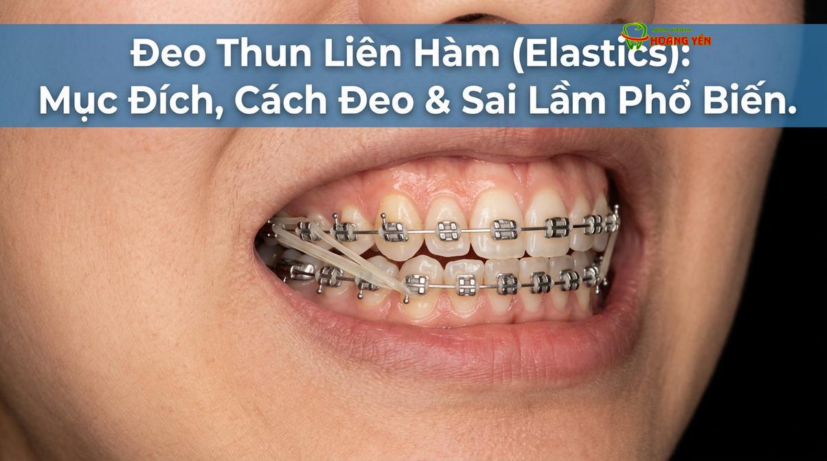 Thun liên hàm được móc nối giữa hai hàm nhằm tạo lực kéo điều chỉnh khớp cắn.