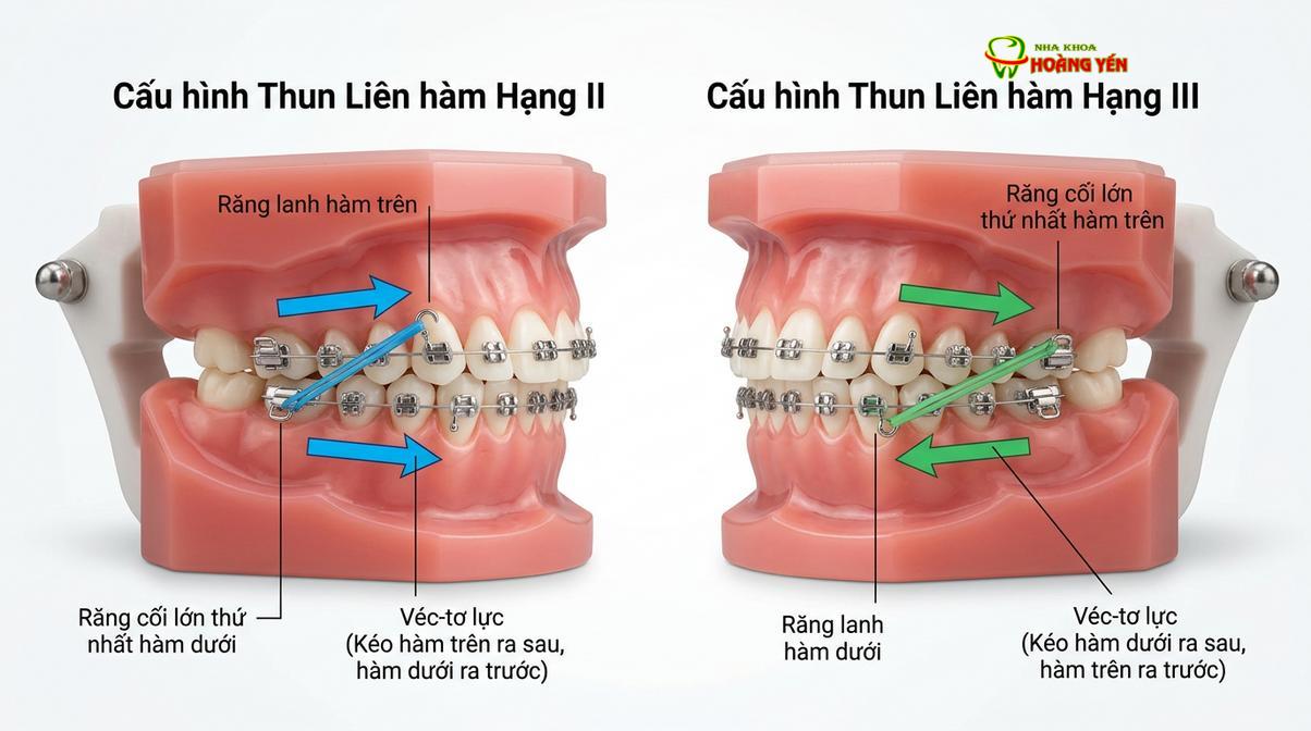 Mô phỏng cơ chế hoạt động và hướng lực kéo của các loại thun chỉnh nha.