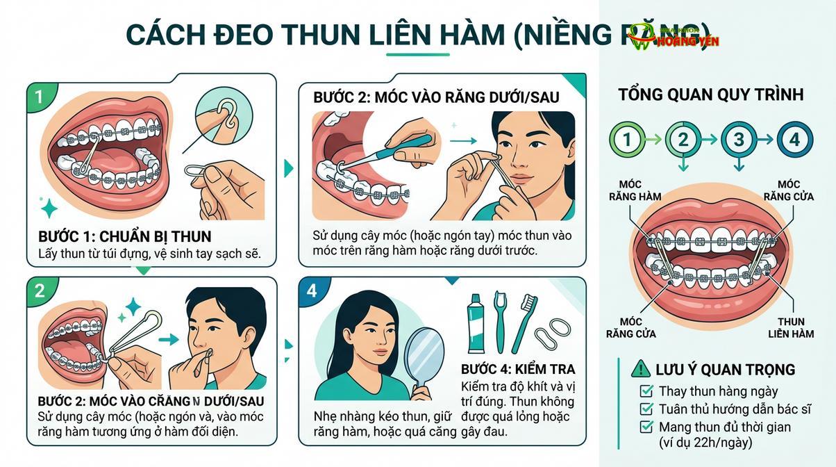 Nhổ răng khôn tạo khoảng trống cần thiết để thun liên hàm kéo lùi toàn hàm.