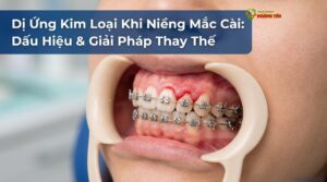 Visual illustration of dị ứng kim loại niềng răng