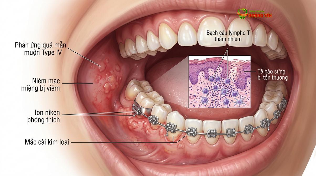 Cơ chế giải phóng ion kim loại trong môi trường nước bọt gây ra phản ứng dị ứng miễn dịch.