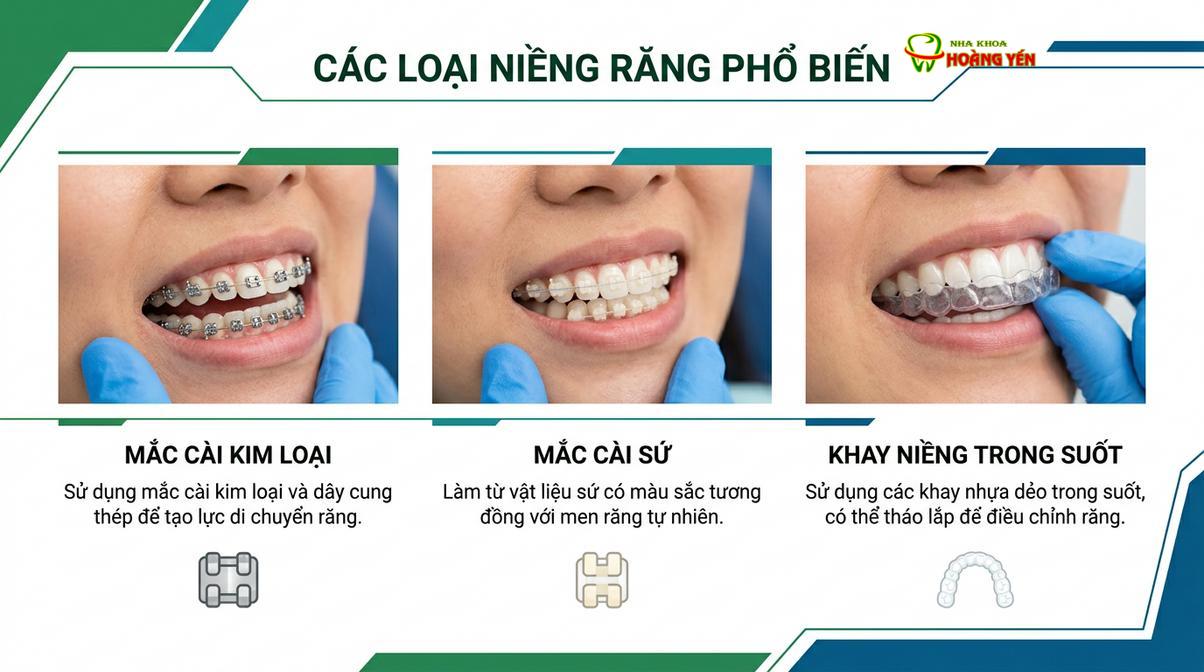 Các phương pháp chỉnh nha phổ biến hiện nay bao gồm mắc cài kim loại, mắc cài sứ và khay trong suốt.
