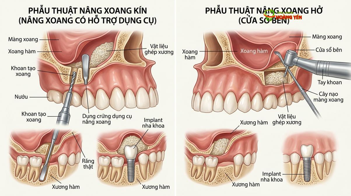 Mô phỏng kỹ thuật nâng xoang giúp gia tăng chiều cao xương hàm trên.