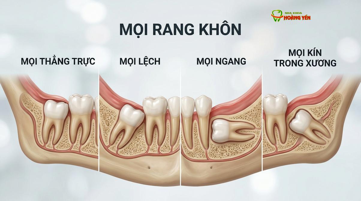 Mô phỏng các cấp độ mọc lệch của răng cối lớn thứ ba ảnh hưởng đến chi phí điều trị