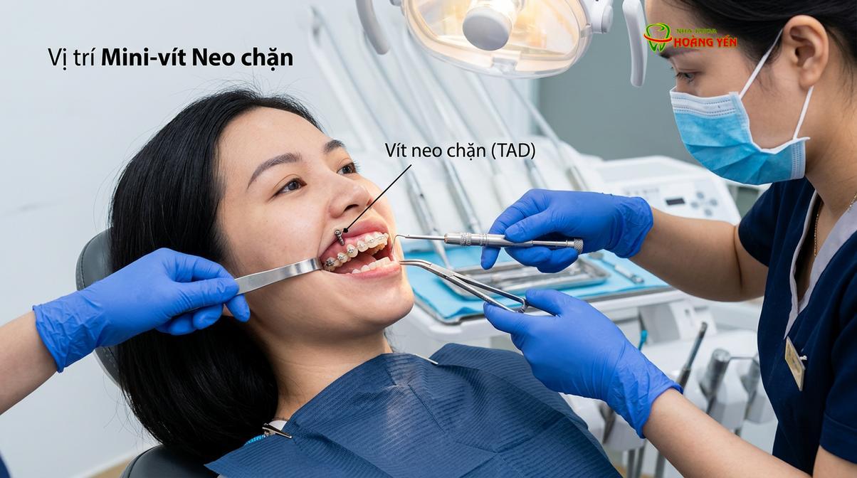 Minivis (TADs) được sử dụng làm điểm neo chặn tuyệt đối trong các ca chỉnh nha phức tạp.