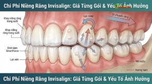 Chi Phí Niềng Răng Invisalign: Giá Từng Gói & Yếu Tố Ảnh Hưởng