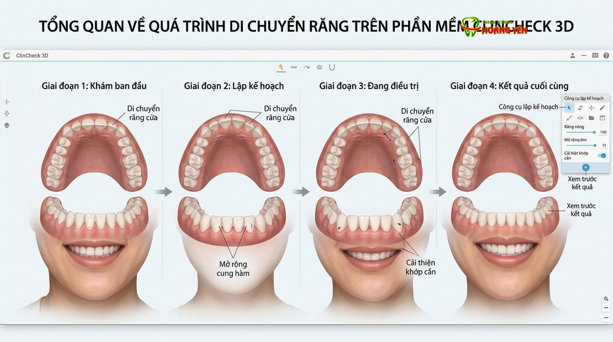 Phần mềm ClinCheck 3D cho phép mô phỏng trước lộ trình dịch chuyển của răng.