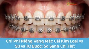 Chi Phí Niềng Răng Mắc Cài Kim Loại vs Sứ vs Tự Buộc: So Sánh Chi Tiết