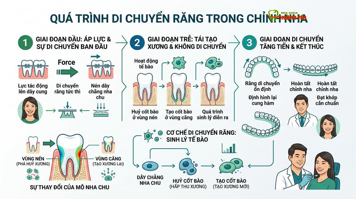 Các giai đoạn dịch chuyển răng sinh lý trong quá trình niềng răng.