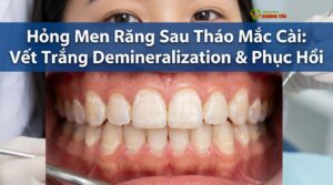 Visual illustration of hỏng men răng sau niềng