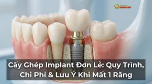 Visual illustration of implant đơn lẻ