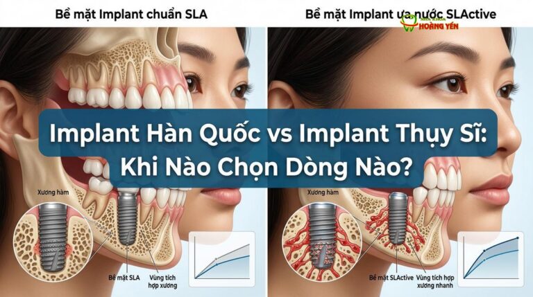 Implant Hàn Quốc vs Implant Thụy Sĩ: Khi Nào Chọn Dòng Nào?