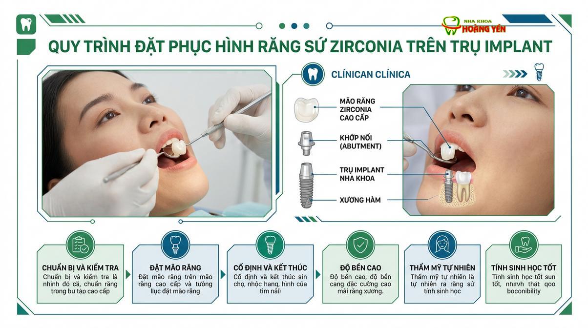 Phục hình răng sứ Zirconia trên implant mang lại thẩm mỹ và chức năng ăn nhai tối ưu.