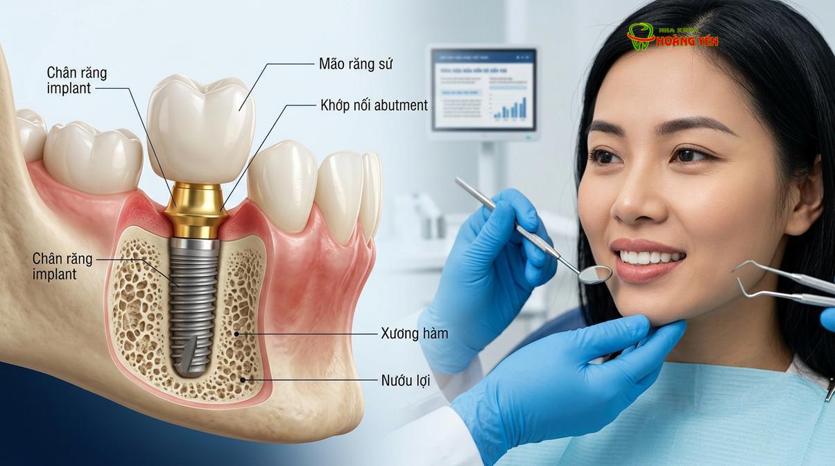 Cấu tạo 3 phần cơ bản của một chiếc răng implant hoàn chỉnh và quá trình tích hợp xương.