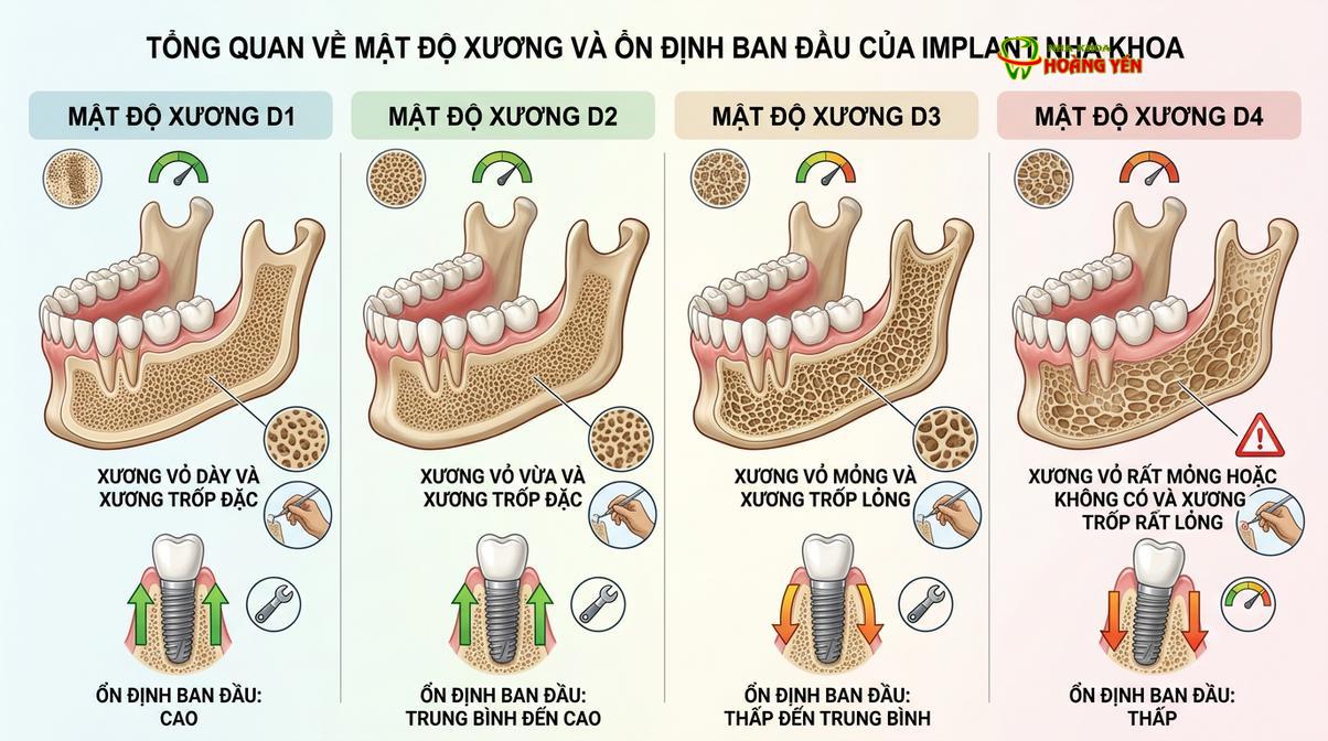 Mô phỏng sự tương quan giữa mật độ xương hàm và độ ổn định ban đầu của trụ implant