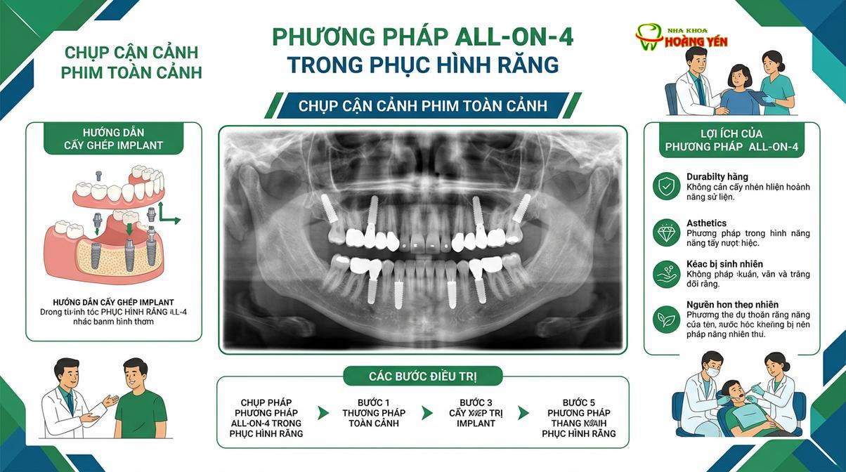 Phim X-quang toàn cảnh đánh giá mức độ tích hợp xương sau khi cấy ghép
