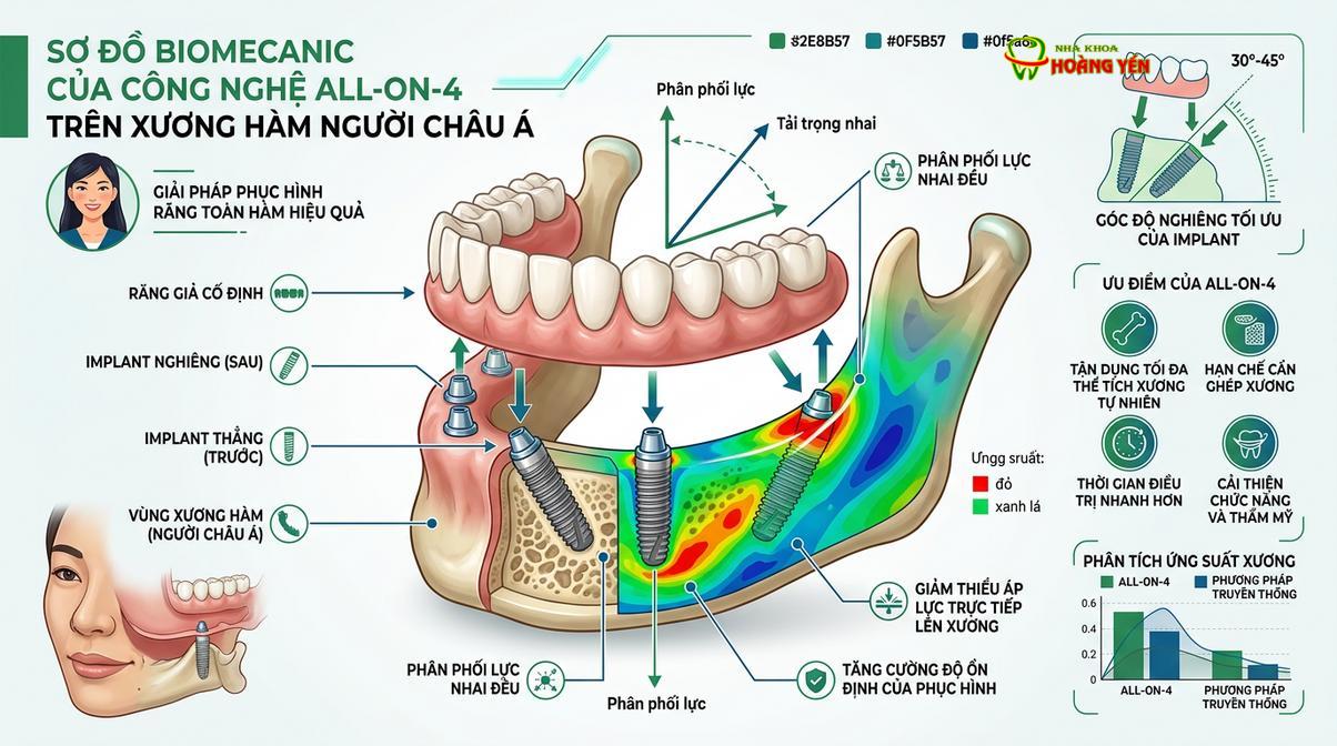 Mô phỏng phân bố lực sinh học trong phục hình toàn hàm All-on-4 sử dụng trụ implant chất lượng cao.