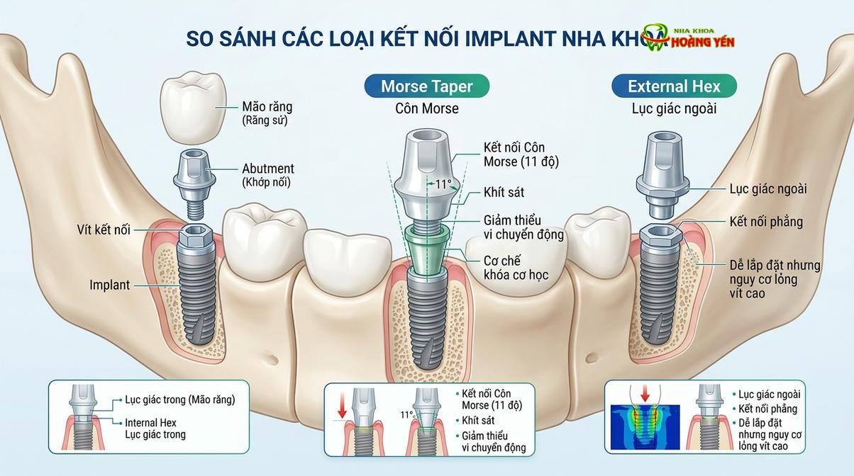 Mô phỏng kết nối Cone Morse giúp hạn chế vi khuẩn xâm nhập