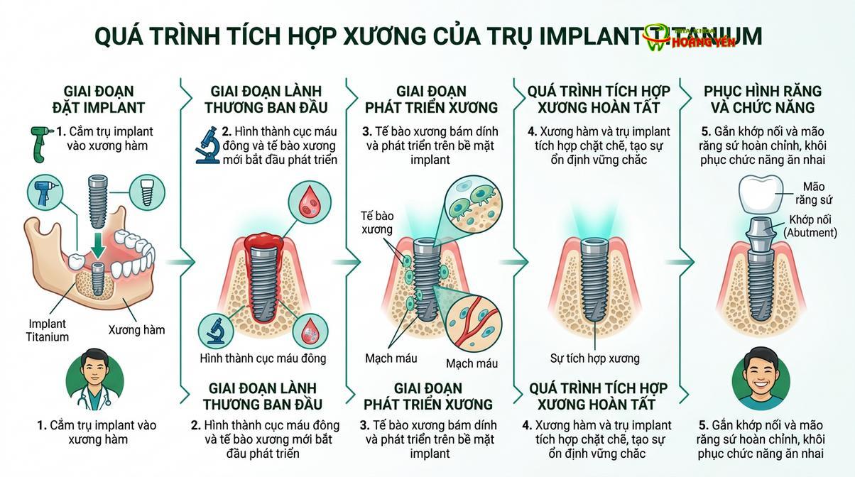 Quá trình tích hợp xương của trụ implant diễn ra an toàn trong môi trường vô trùng