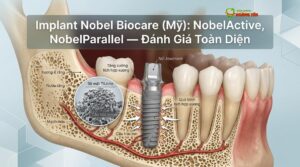 Visual illustration of implant nobel biocare