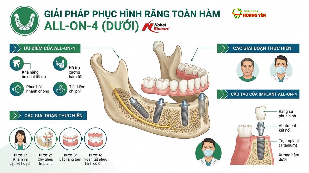 Mô phỏng kỹ thuật phục hình toàn hàm All-on-4 với hệ thống trụ cao cấp