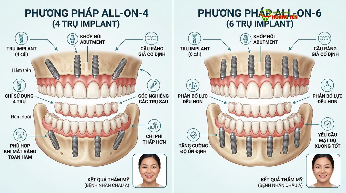 Mô phỏng kỹ thuật phục hình toàn hàm All-on-4 và All-on-6.